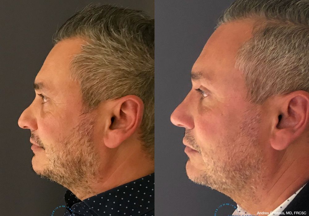 Revision Rhinoplasty - Thumbnail 5