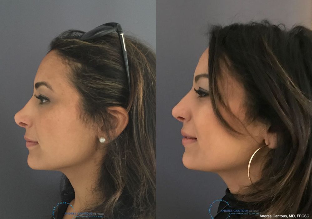 Revision Rhinoplasty - Thumbnail 6