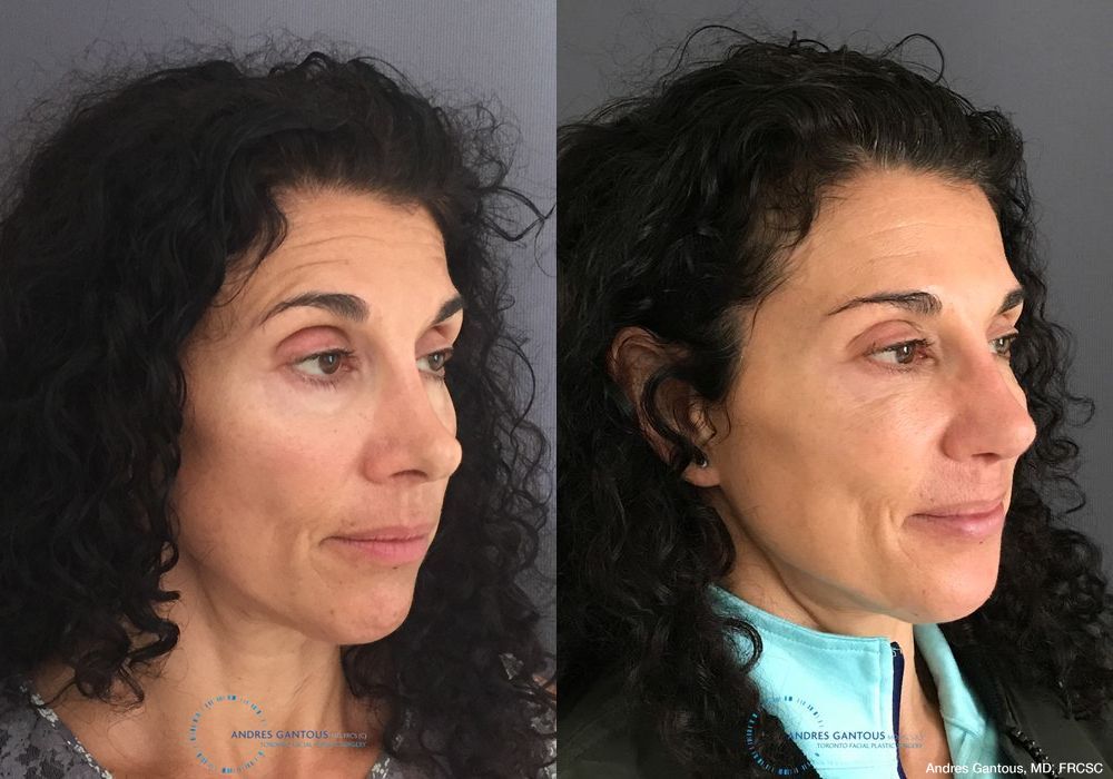 Revision Rhinoplasty - Thumbnail 4