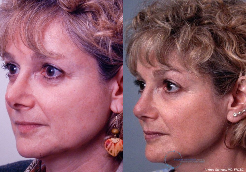 Revision Rhinoplasty - Thumbnail 4