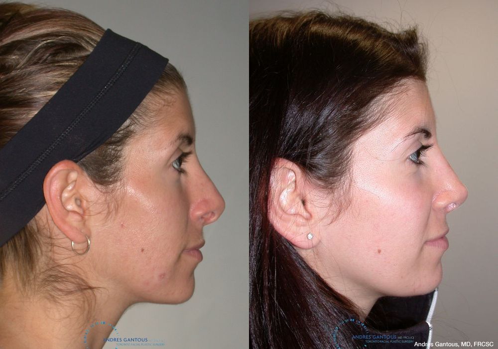 Revision Rhinoplasty - Thumbnail 5