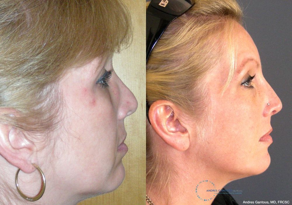 Revision Rhinoplasty - Thumbnail 5