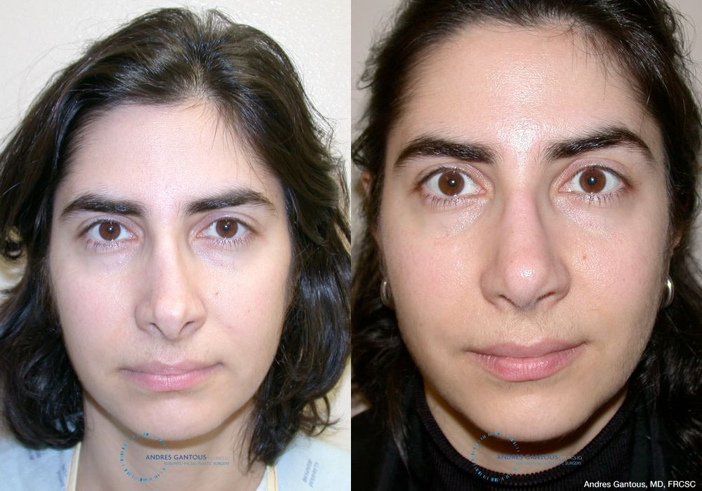 Revision Rhinoplasty - Case 6651