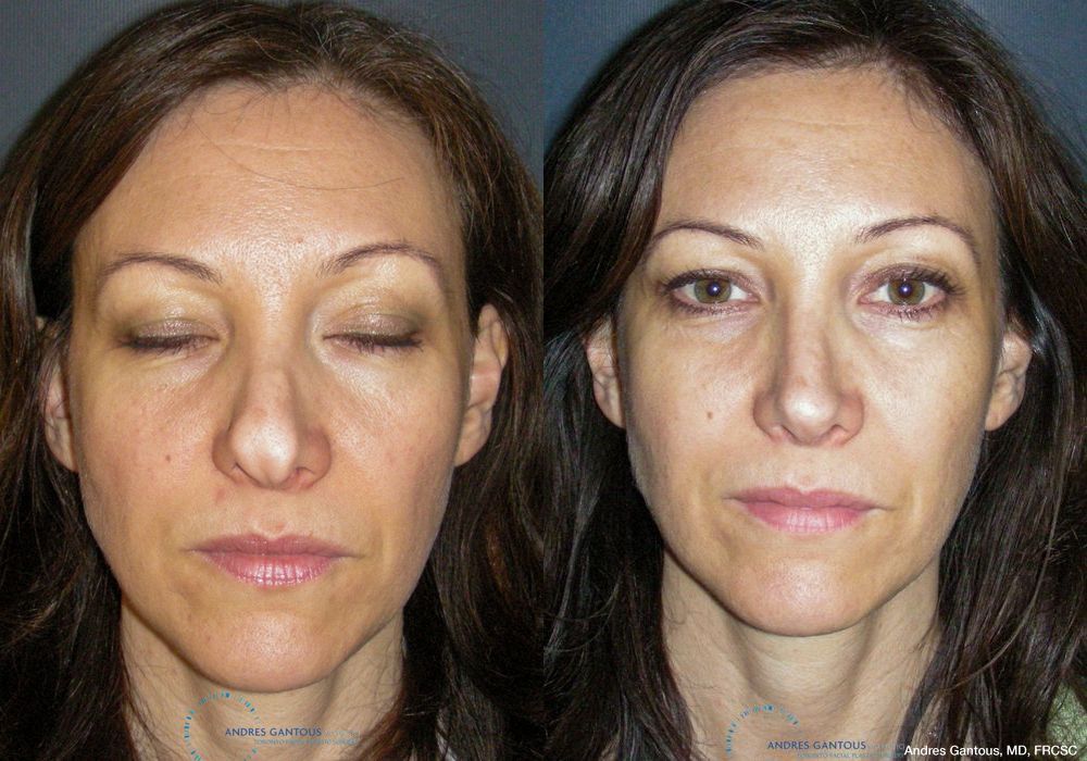 Revision Rhinoplasty - Case 6650