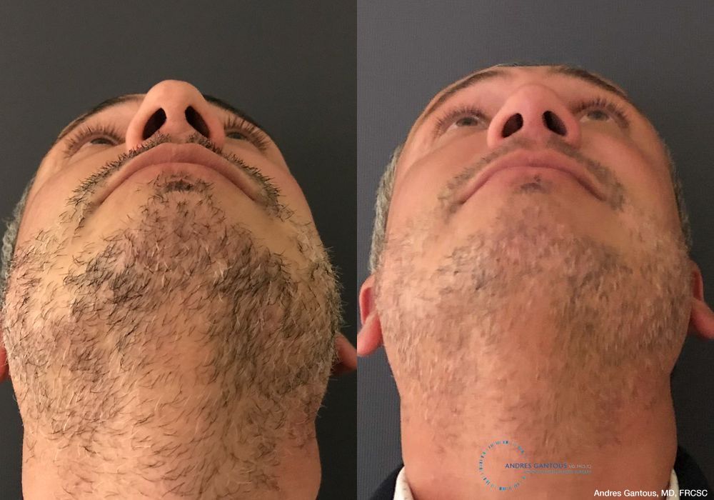 Revision Rhinoplasty - Thumbnail 2