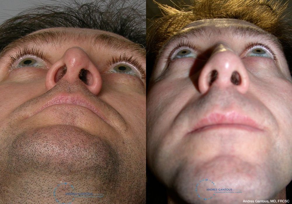 Revision Rhinoplasty - Thumbnail 2