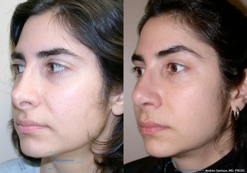 Revision Rhinoplasty - Thumbnail 3