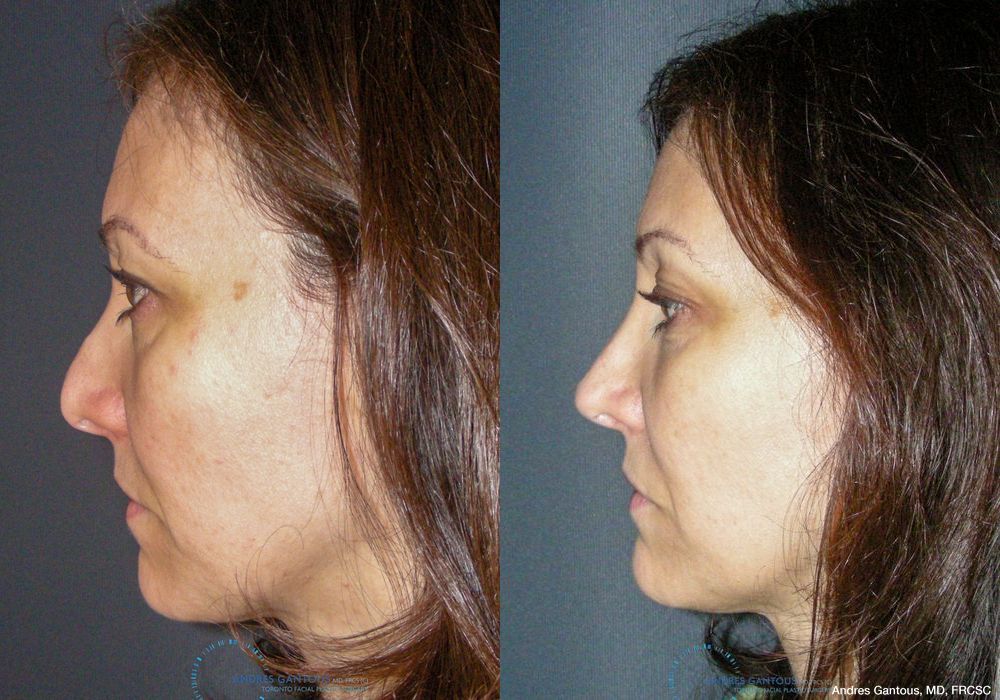 Revision Rhinoplasty - Thumbnail 6