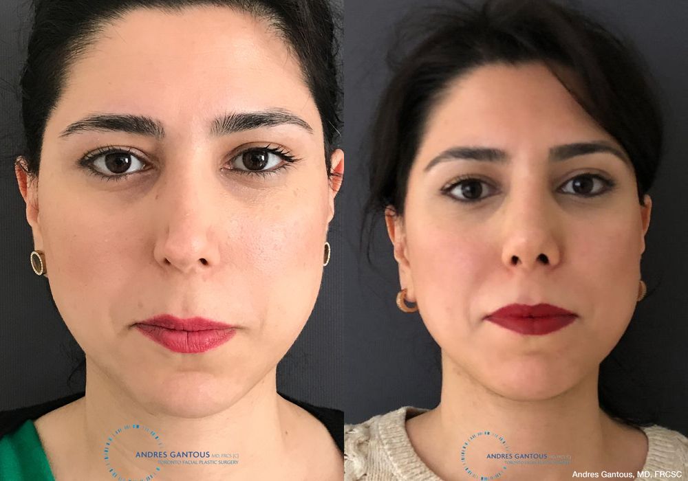 Revision Rhinoplasty - Case 6654