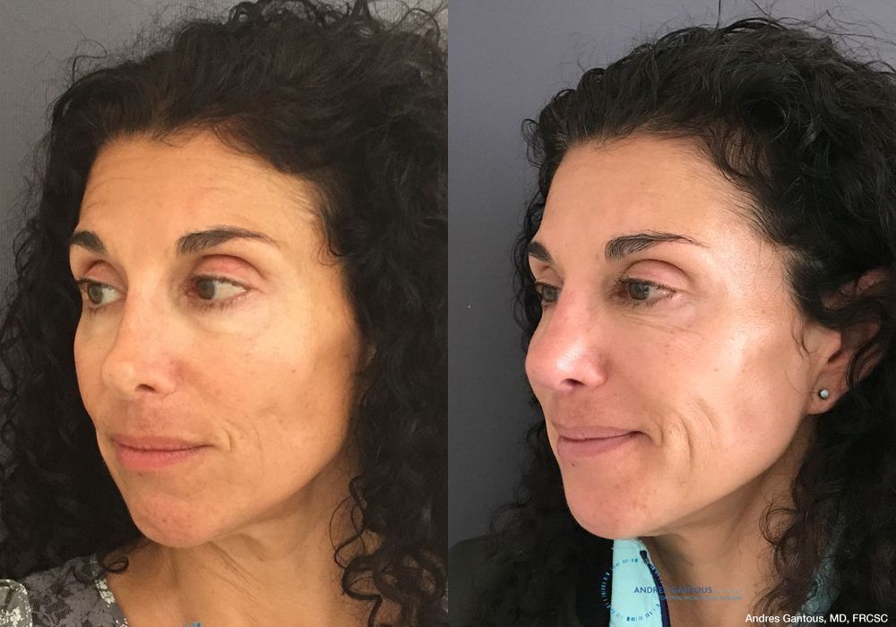 Revision Rhinoplasty - Thumbnail 3