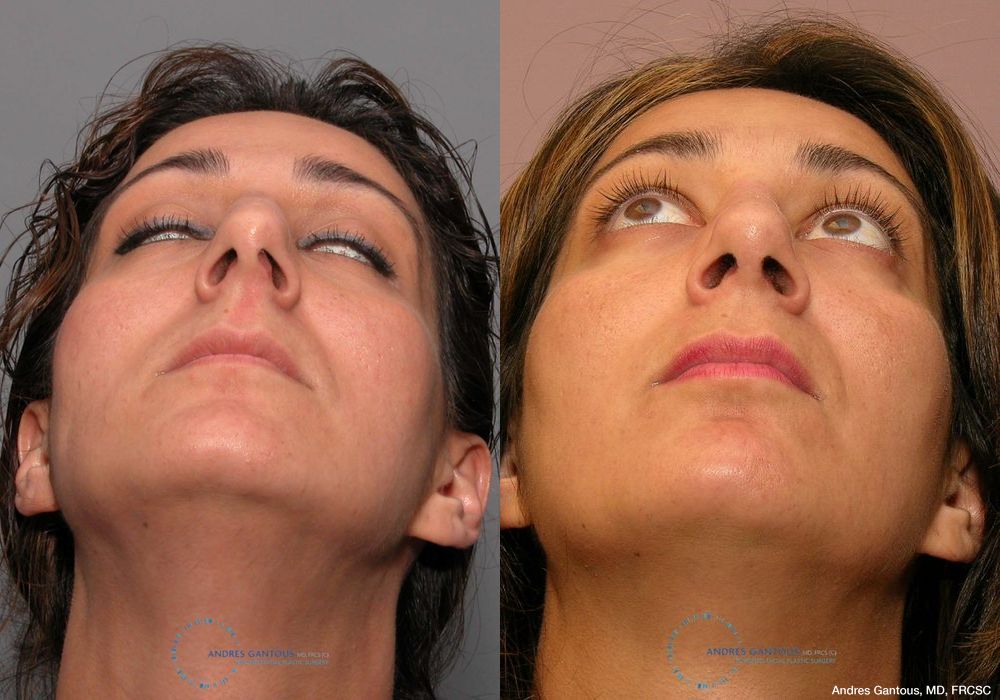 Revision Rhinoplasty - Thumbnail 2