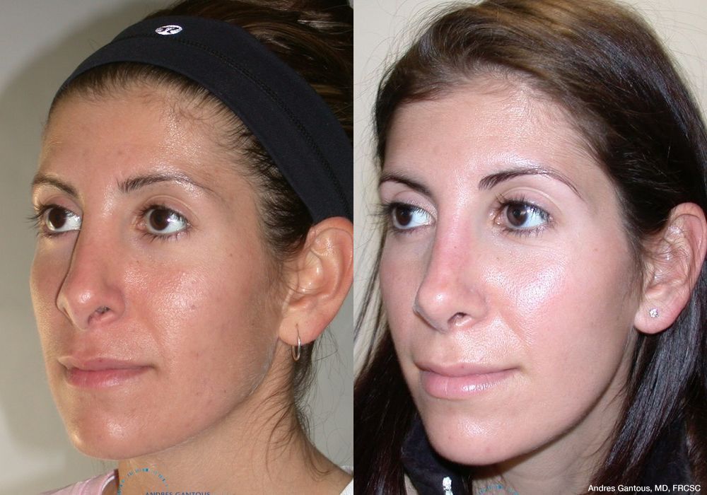 Revision Rhinoplasty - Thumbnail 3