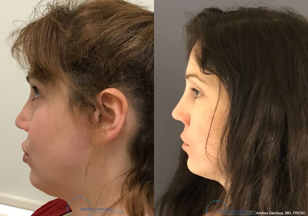 Revision Rhinoplasty - Thumbnail 6