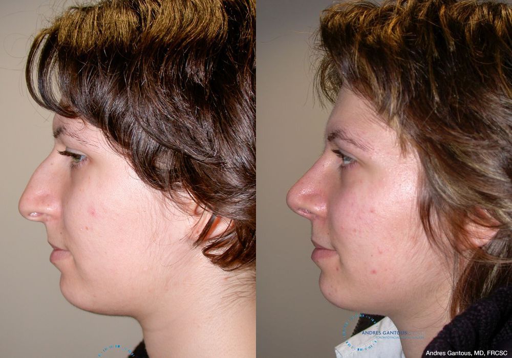 Rhinoplasty - Thumbnail 5