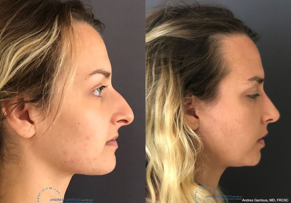 Rhinoplasty - Thumbnail 5