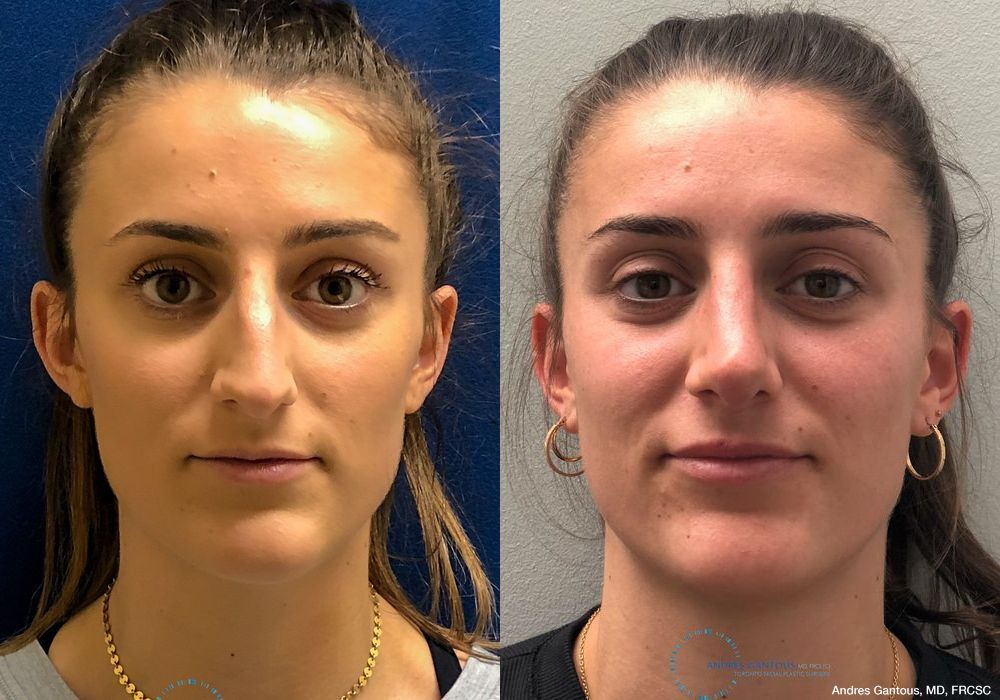 Rhinoplasty - Case 7159