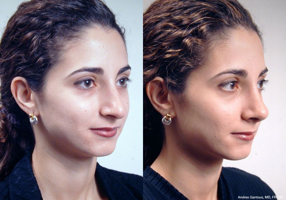 Rhinoplasty - Thumbnail 3