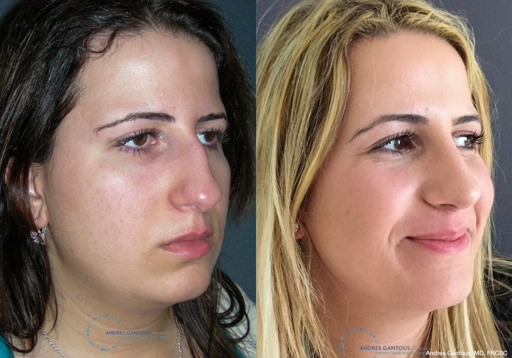 Rhinoplasty - Thumbnail 3