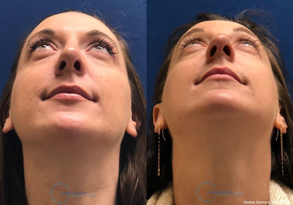 Rhinoplasty - Thumbnail 2