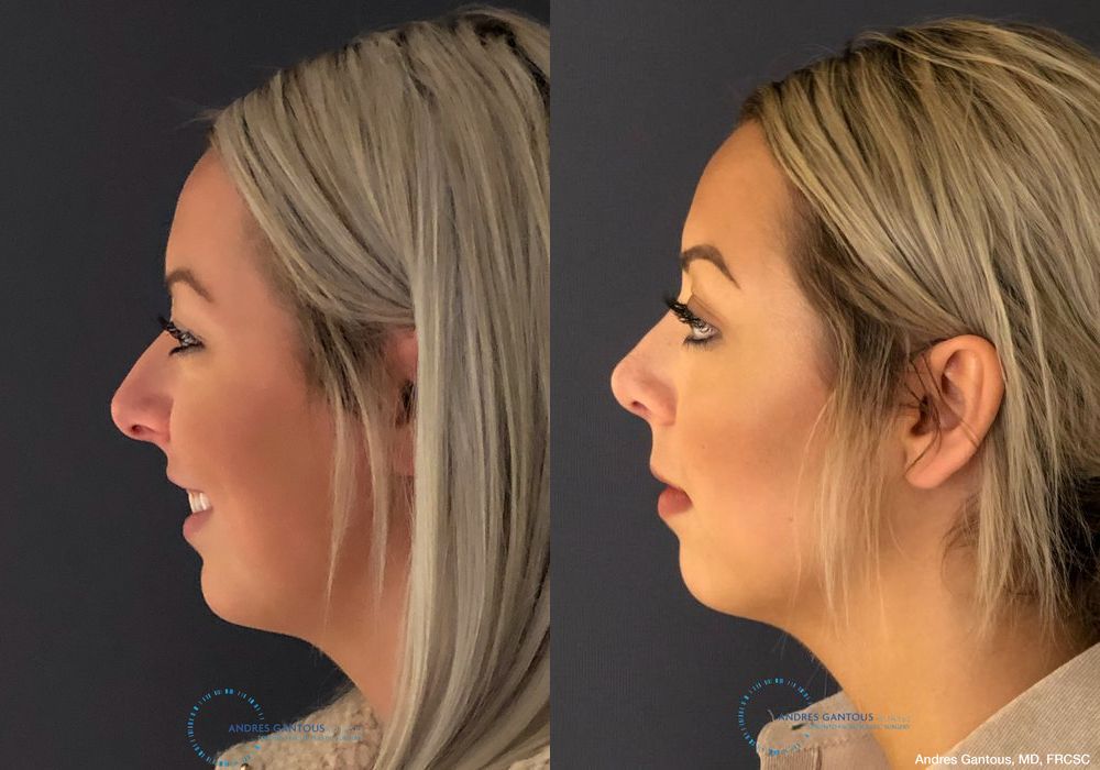 Rhinoplasty - Thumbnail 5