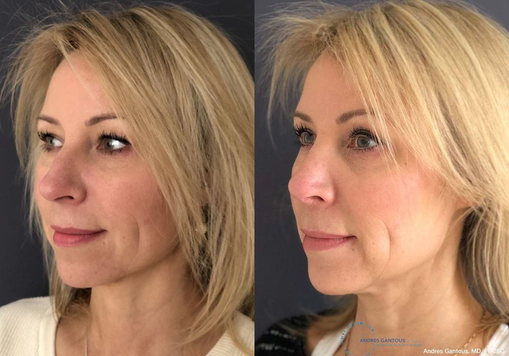 Rhinoplasty - Thumbnail 4