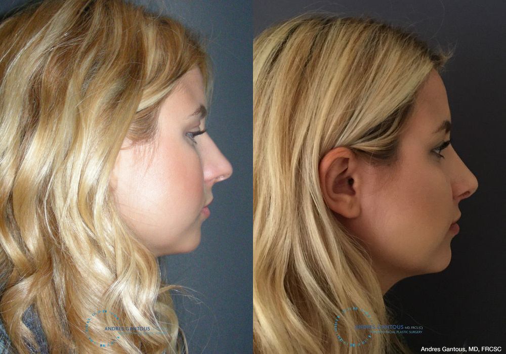 Rhinoplasty - Thumbnail 5