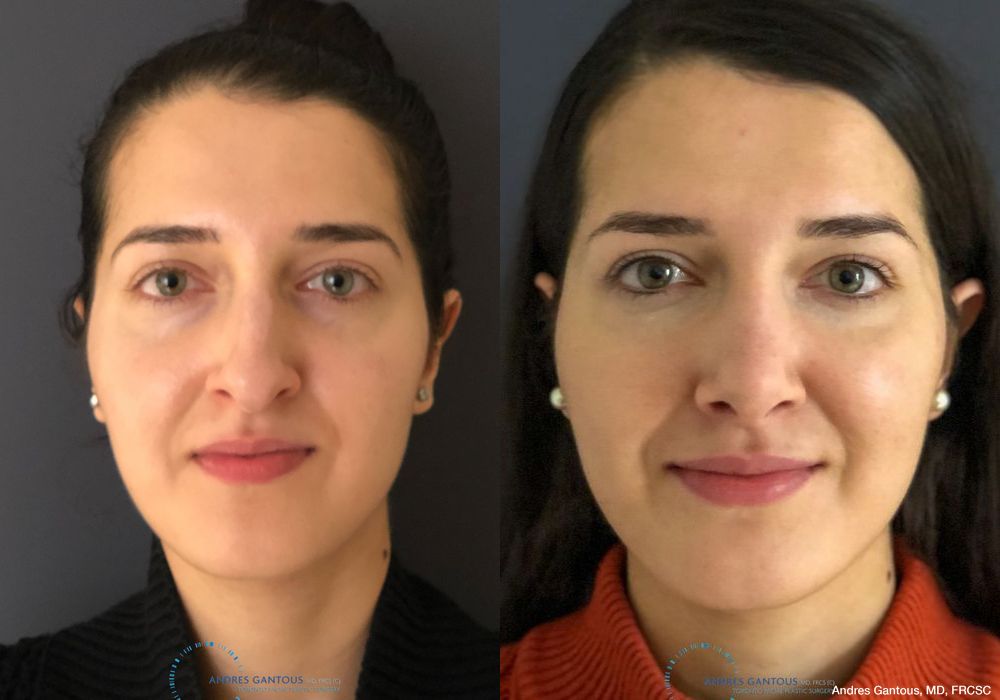 Rhinoplasty - Case 6435