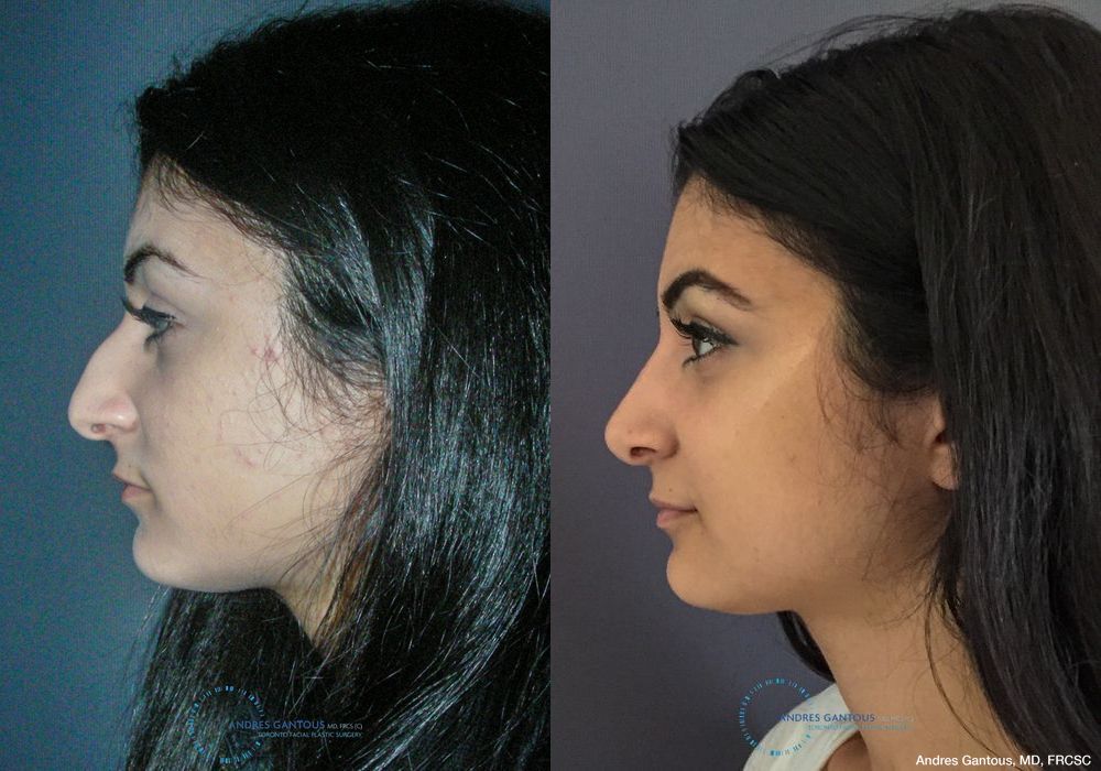 Rhinoplasty - Thumbnail 6