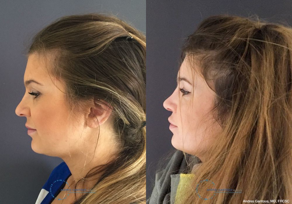 Rhinoplasty - Thumbnail 6