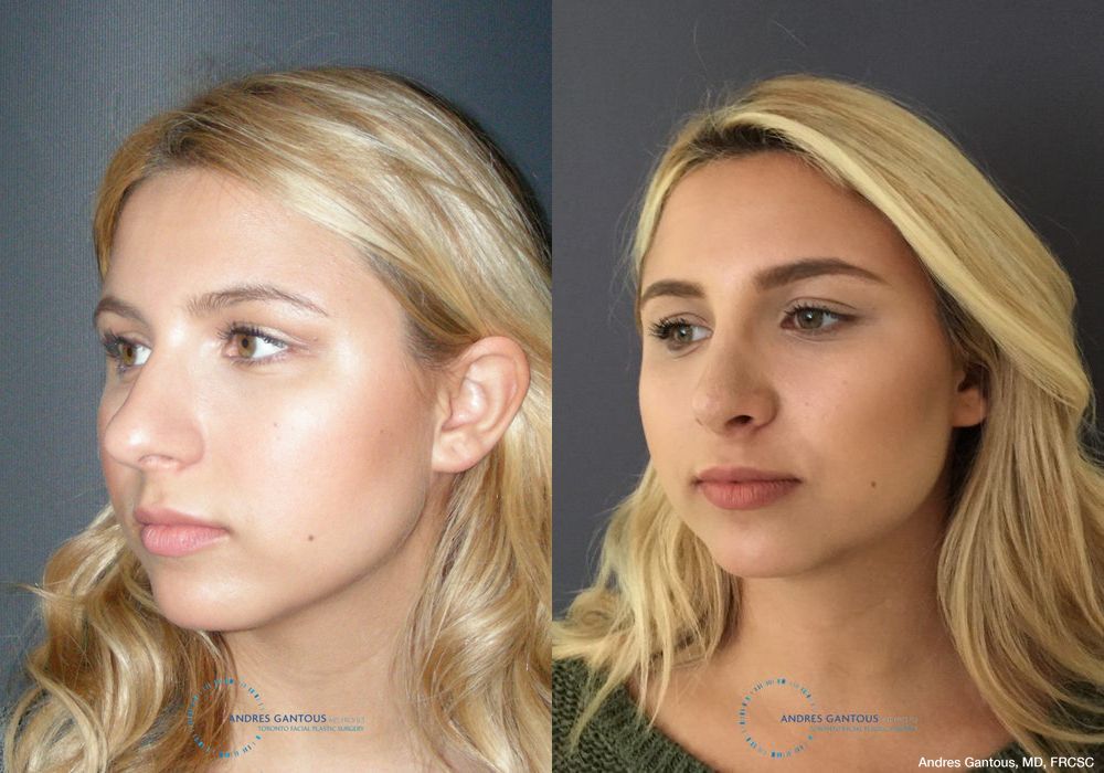 Rhinoplasty - Thumbnail 4