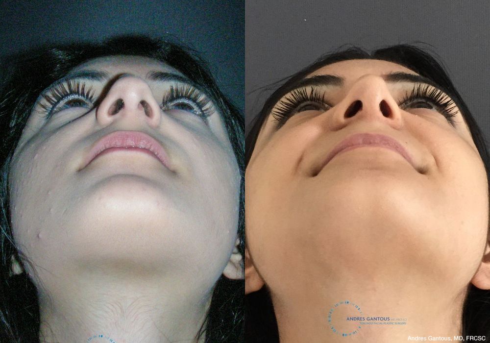 Rhinoplasty - Thumbnail 2