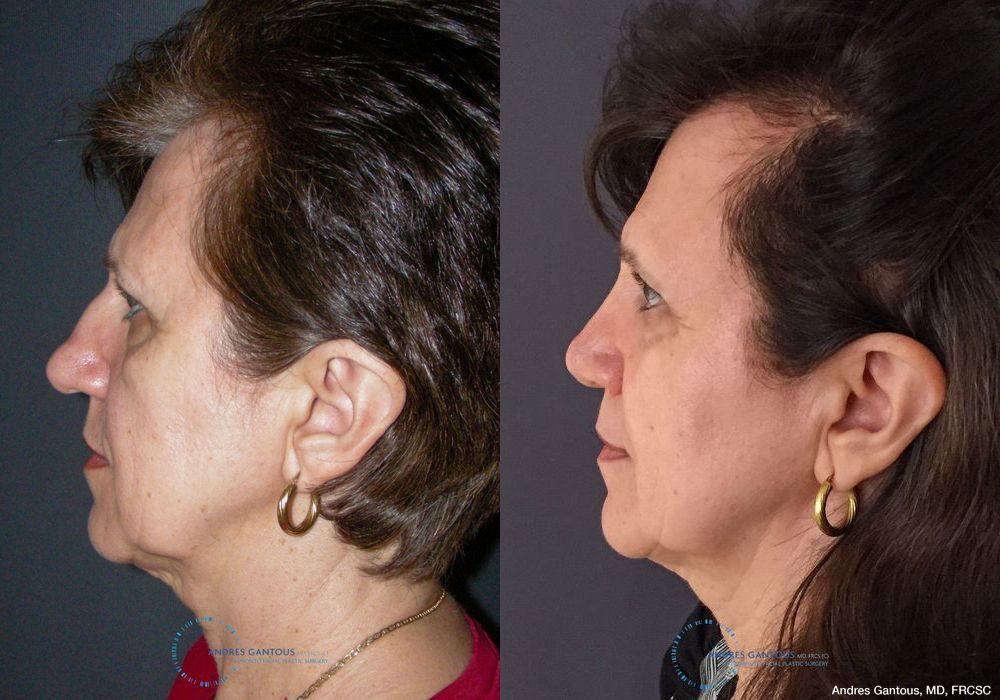 Rhinoplasty - Thumbnail 6