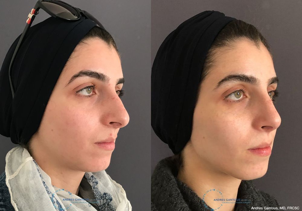 Rhinoplasty - Thumbnail 3