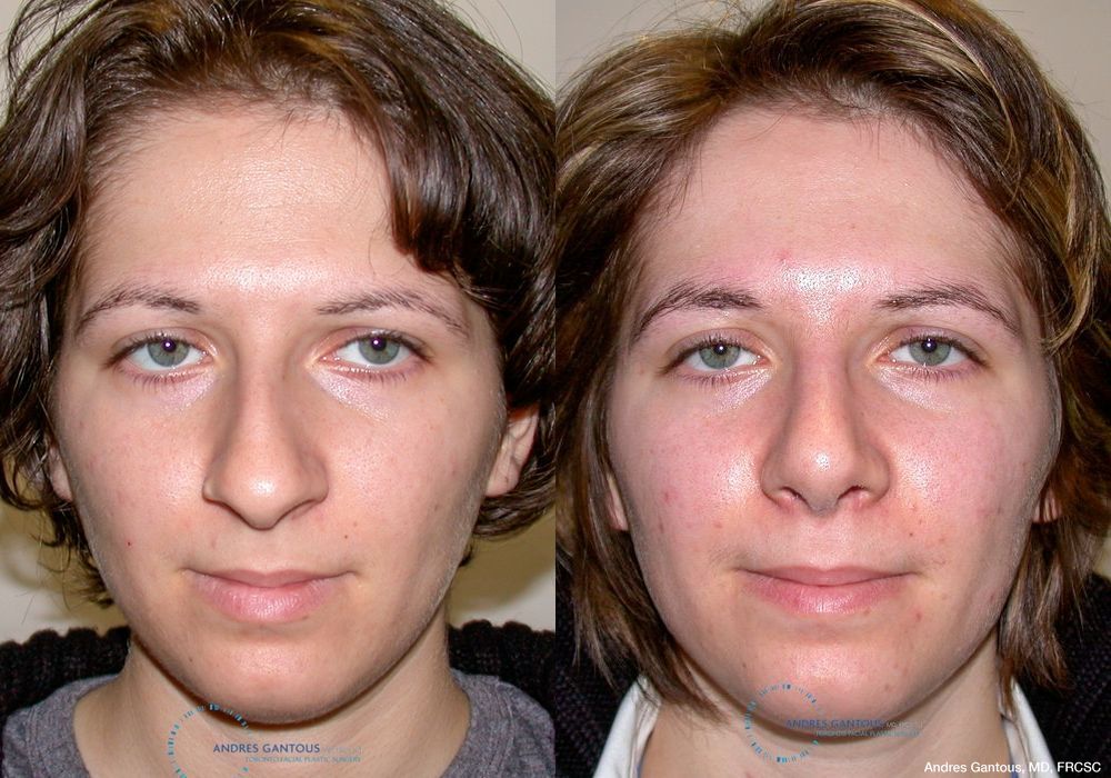 Rhinoplasty - Case 6746