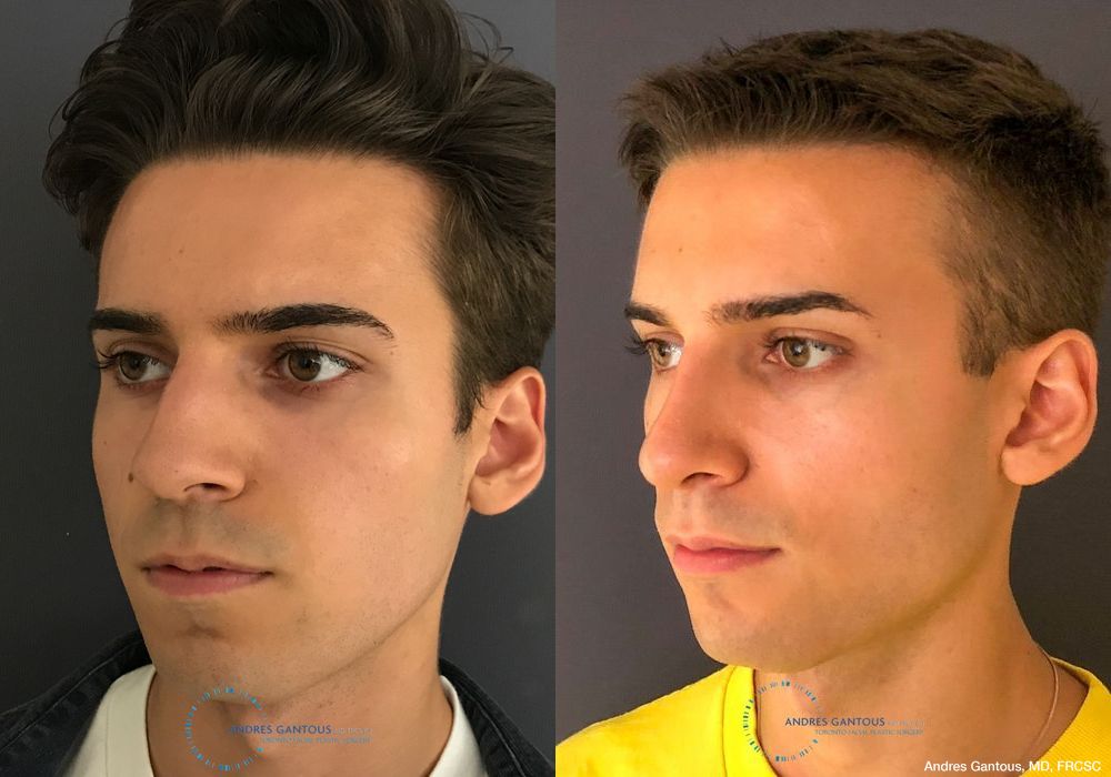 Rhinoplasty - Thumbnail 3