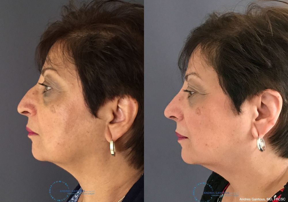 Rhinoplasty - Thumbnail 6