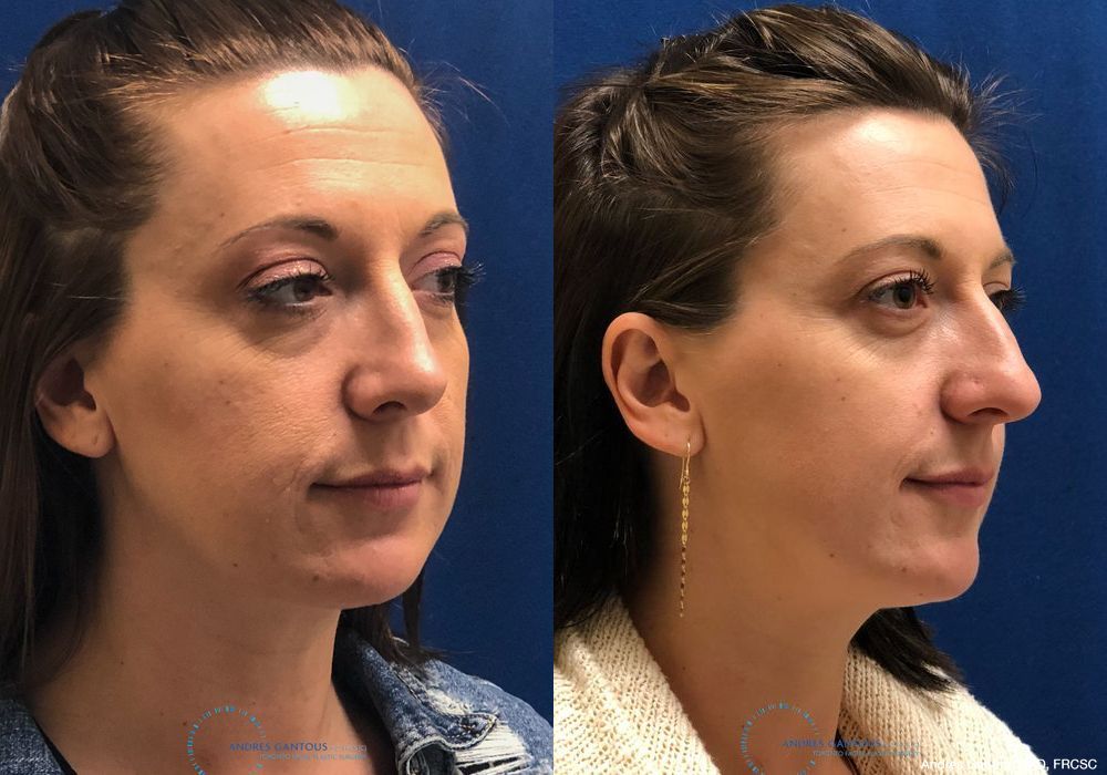 Rhinoplasty - Thumbnail 4