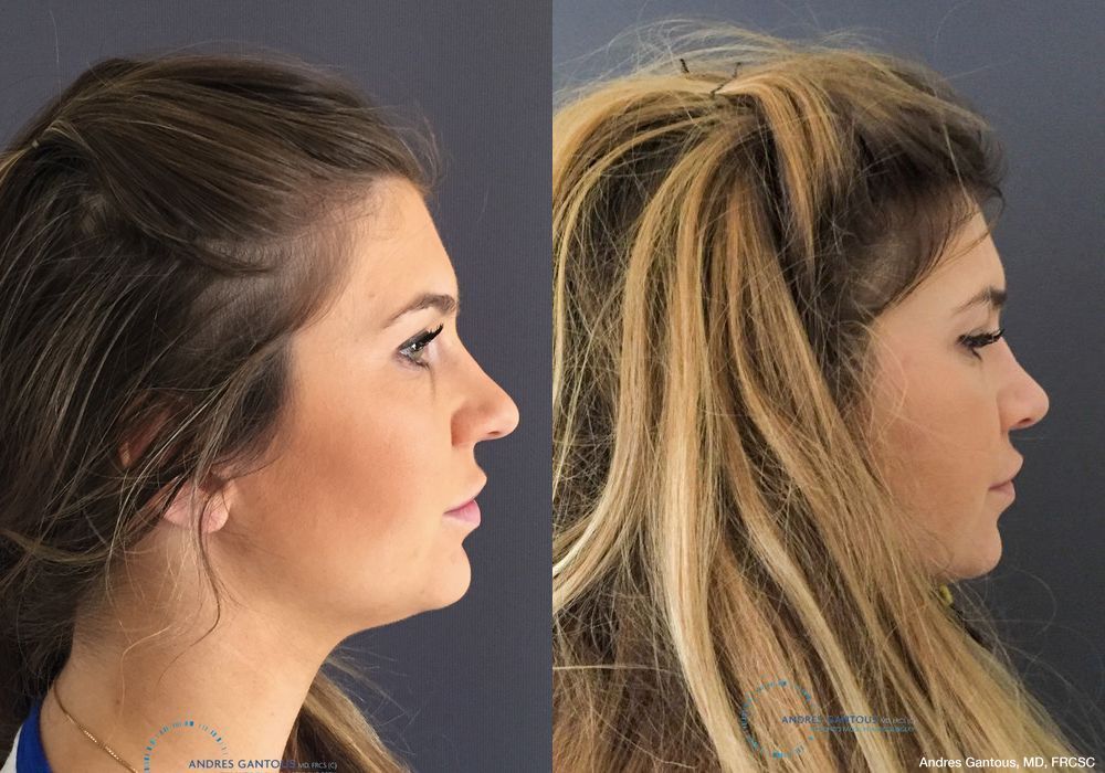 Rhinoplasty - Thumbnail 5