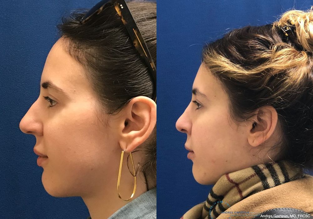 Rhinoplasty - Thumbnail 6