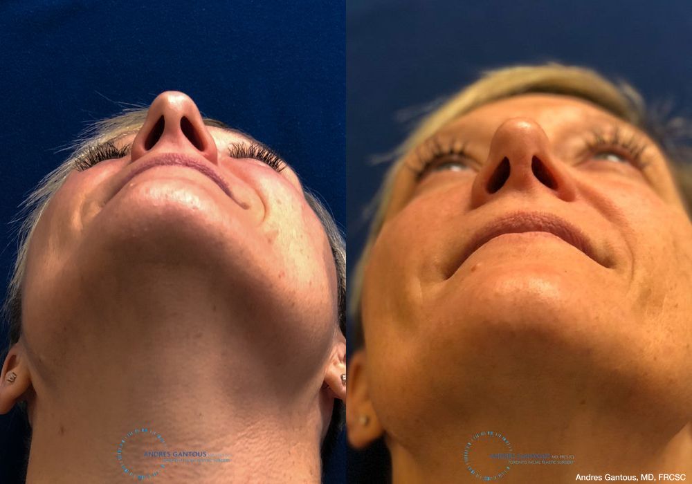 Rhinoplasty - Thumbnail 2