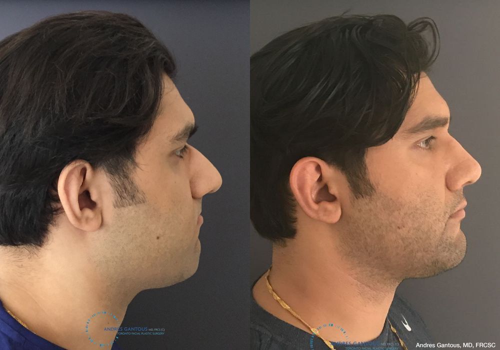 Before and after Rhinoplasty case 11649 - Angle 5