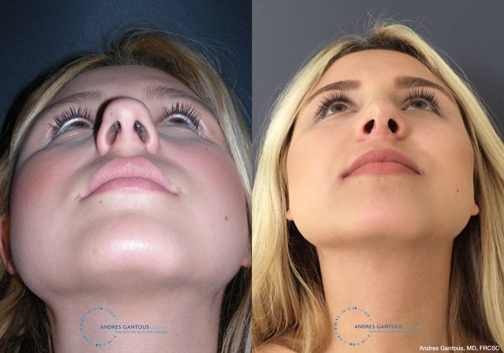 Rhinoplasty - Thumbnail 2
