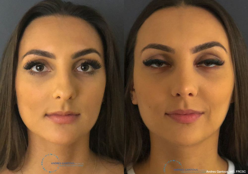 Rhinoplasty - Case 6433