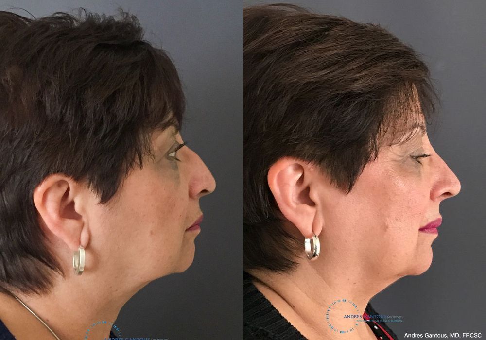 Rhinoplasty - Thumbnail 5