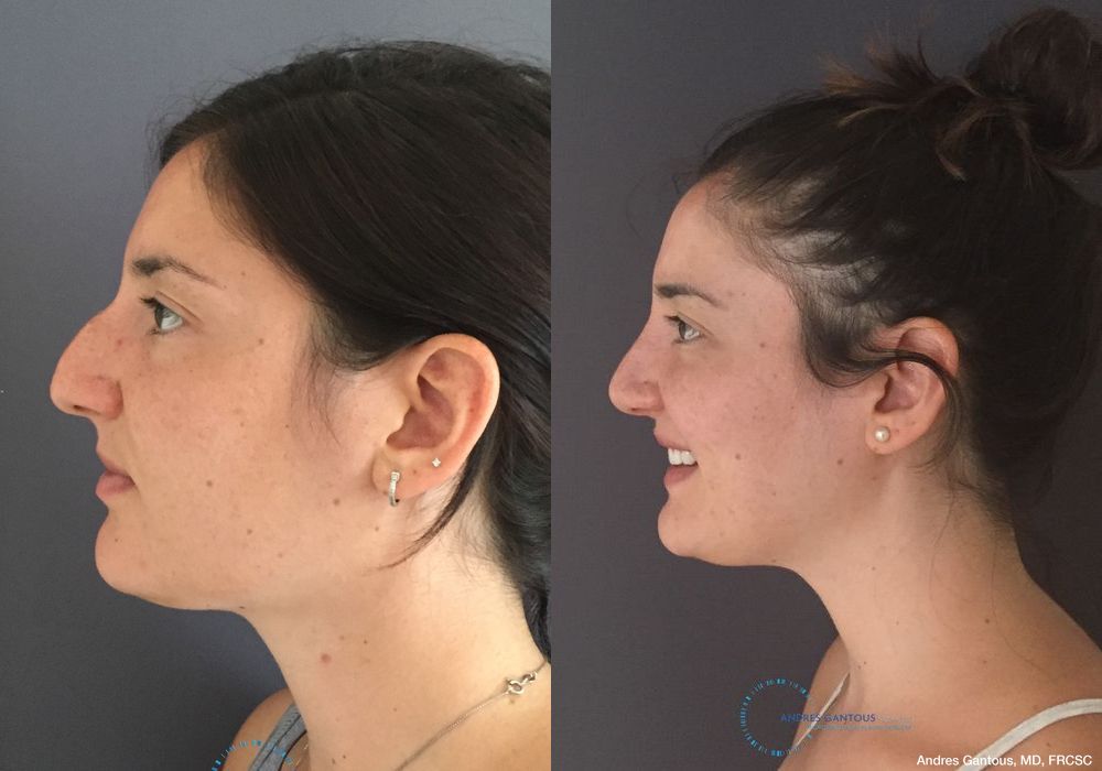 Rhinoplasty - Thumbnail 6