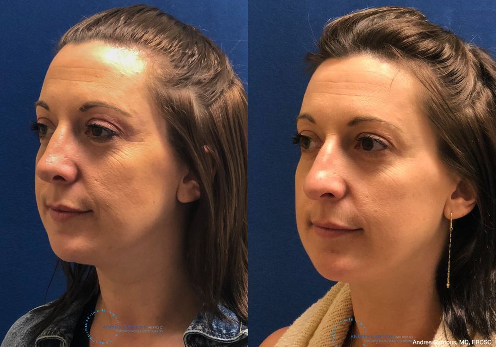 Rhinoplasty - Thumbnail 3