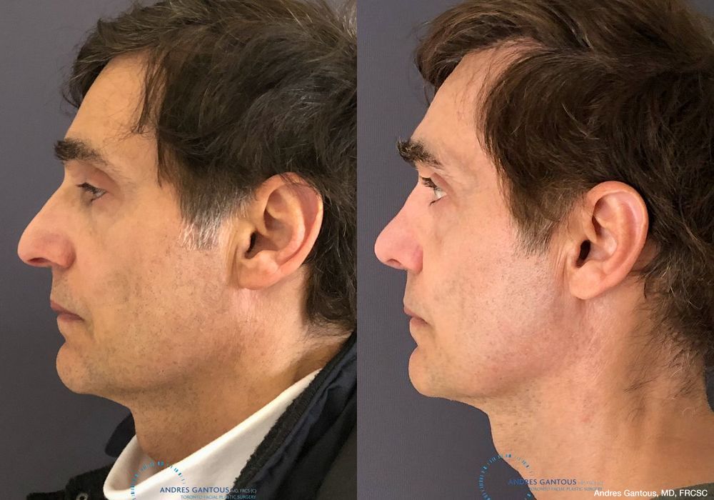 Rhinoplasty - Thumbnail 6