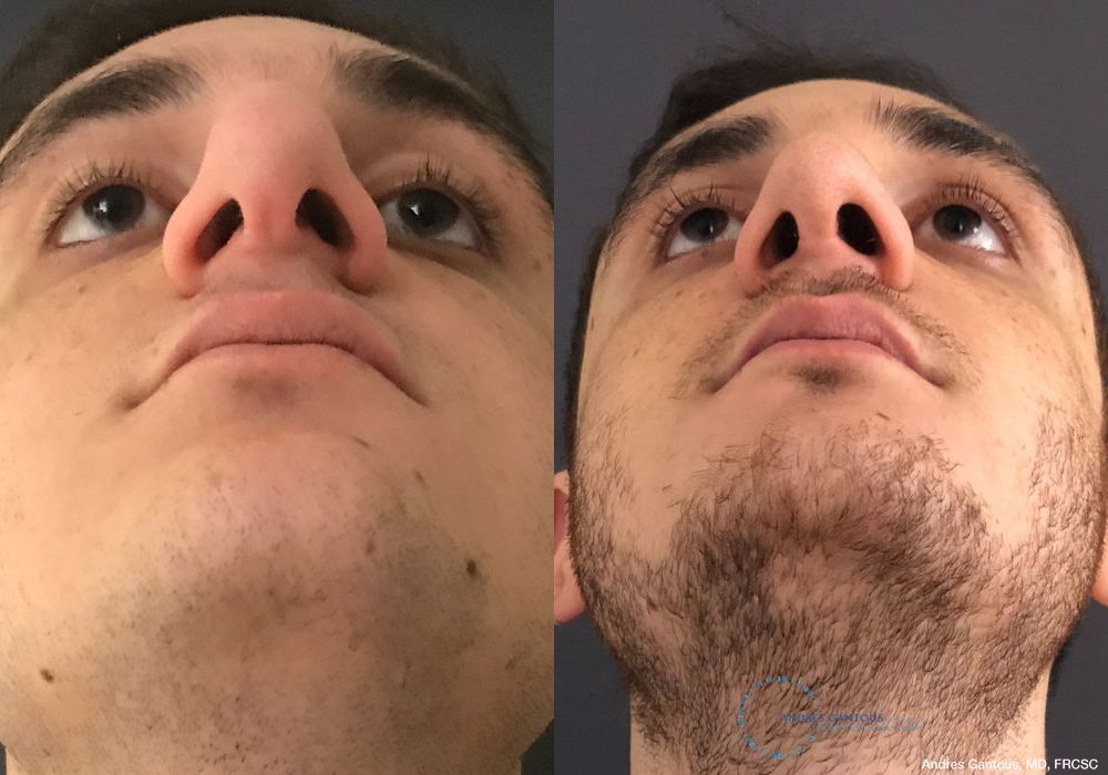 Rhinoplasty - Thumbnail 2