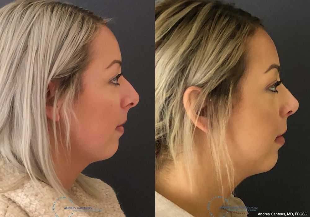 Rhinoplasty - Thumbnail 6