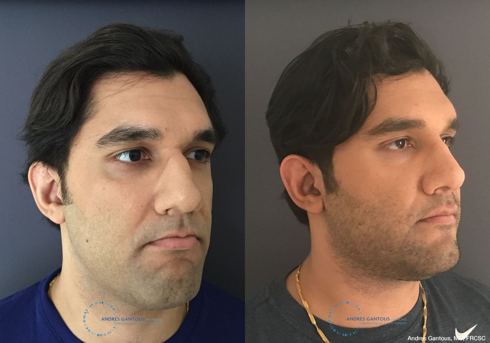 Before and after Rhinoplasty case 11649 - Angle 3
